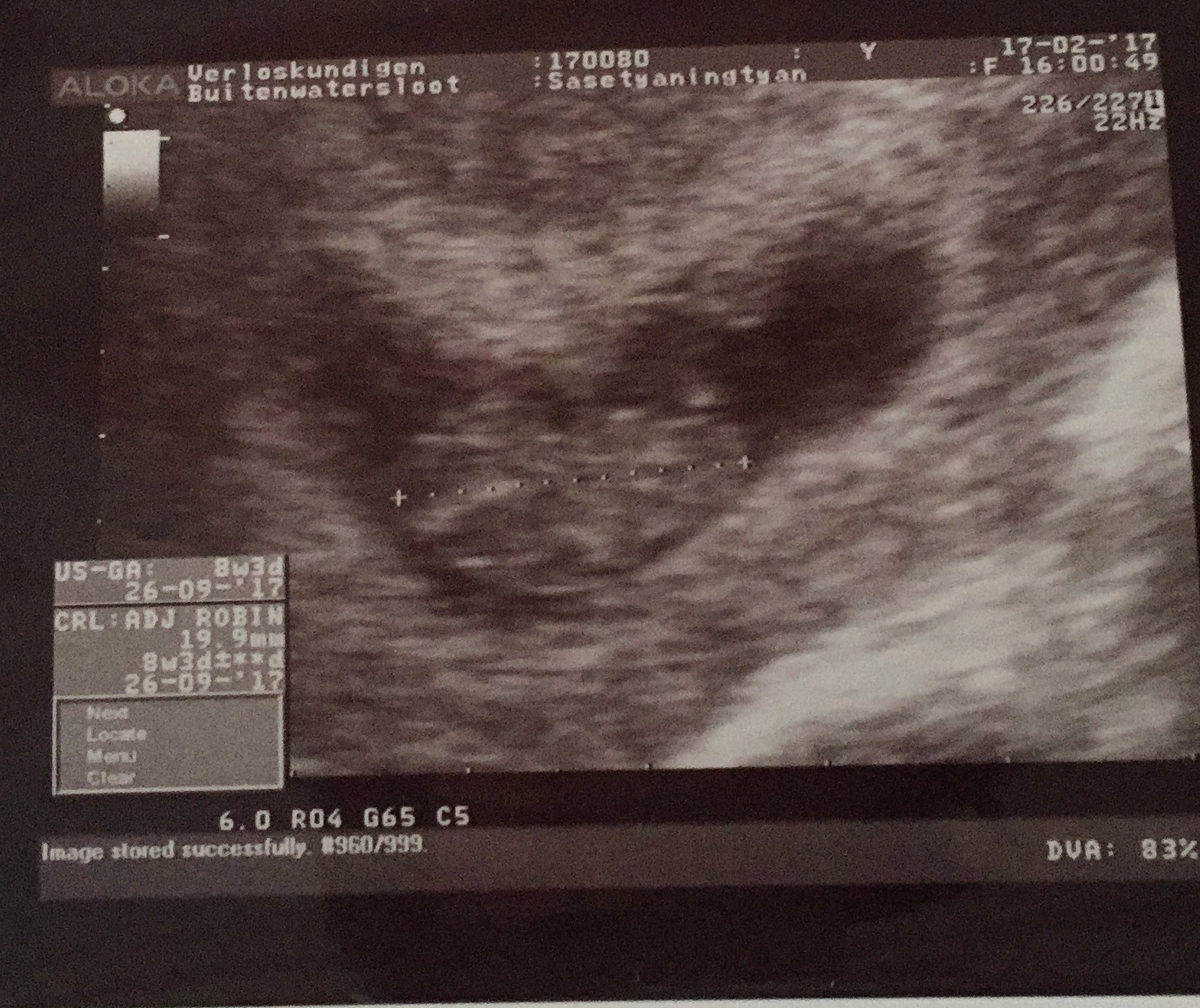 USG kehamilan pertama
